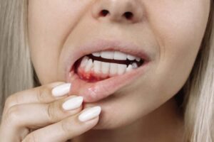Questo sintomo può rappresentare un indicatore di condizioni cliniche serie, tra cui la leucemia.