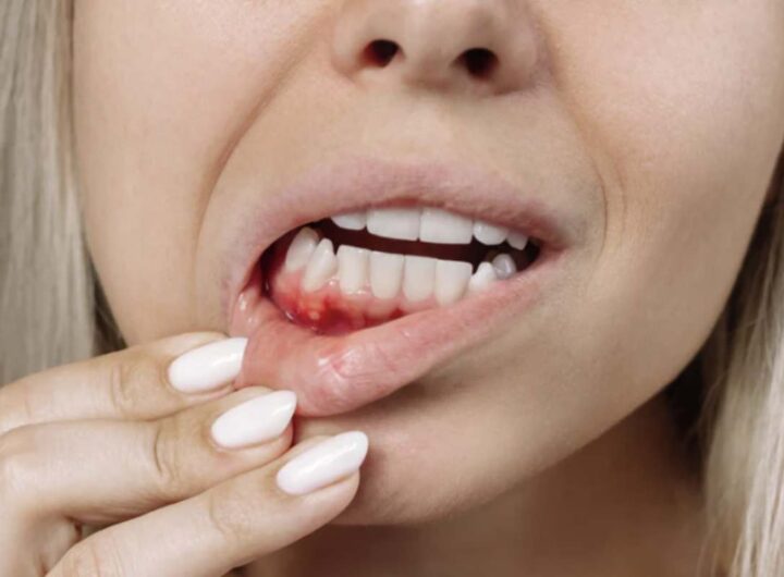 Questo sintomo può rappresentare un indicatore di condizioni cliniche serie, tra cui la leucemia.